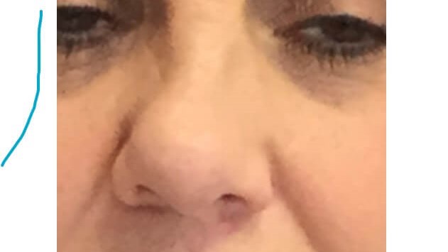nasal fracture with deviation 