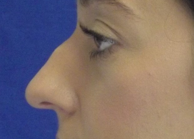 nasal fracture causing a bump