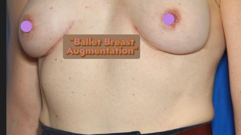 Dr Suzman Breast Impalnts