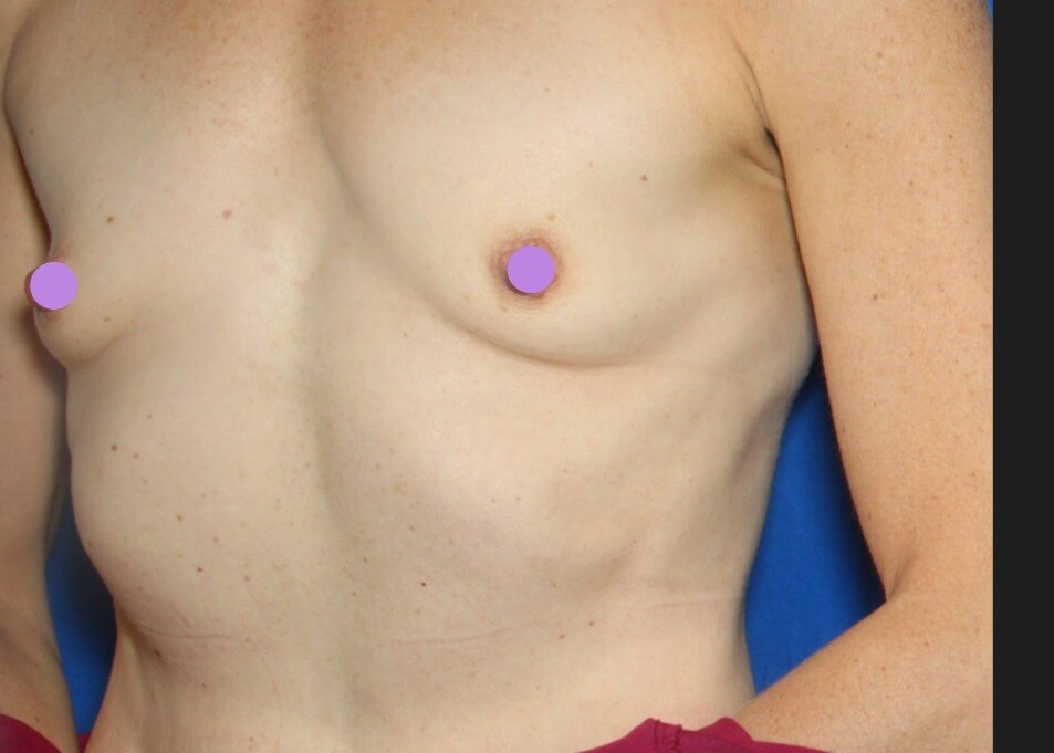 Dr Suzman Breat Augmentation