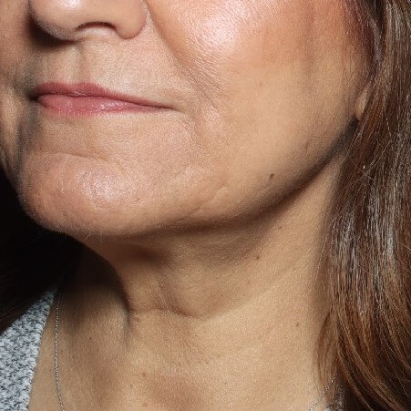 post op Phase 2 Limited Neck l