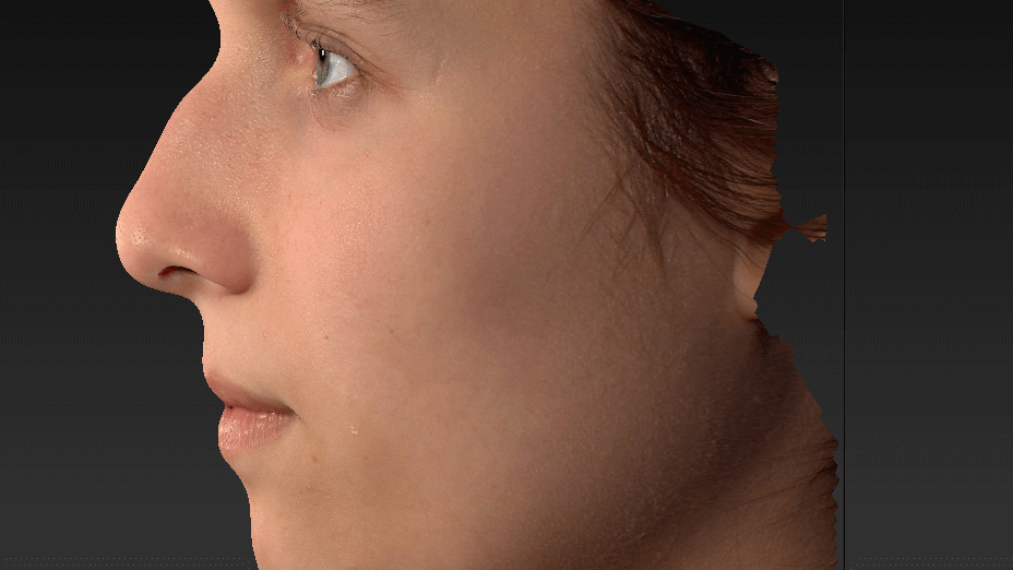 Before Rhinoplasty