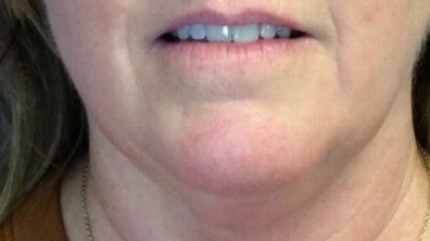 Dr Suzman Neck Lift Post op