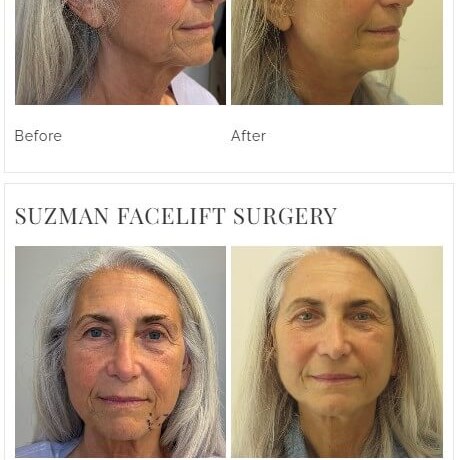 Dr Suzman Facelift Deep Plane 