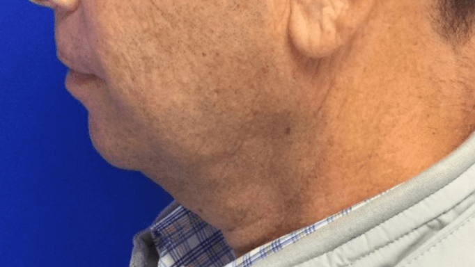 Dr SUzman male facelift and fa