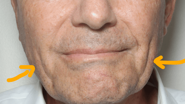 Jawline skin looseness 70 yo m