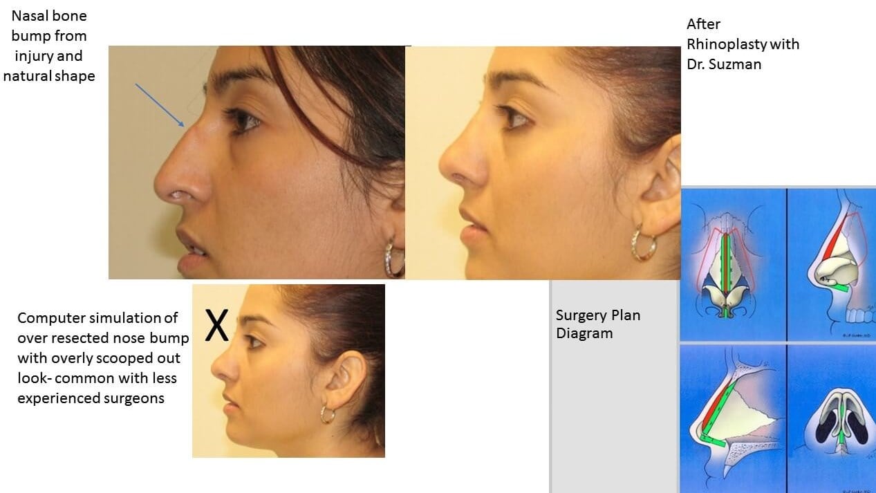 Choosing a Nose Shape and Nose Size when Considering Rhinoplasty