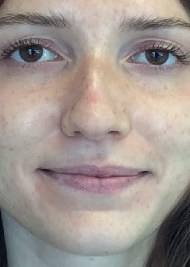narrow mid vault nose Dr Suzma